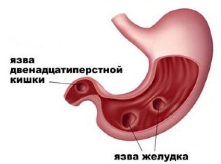 Как проявляется язва желудка