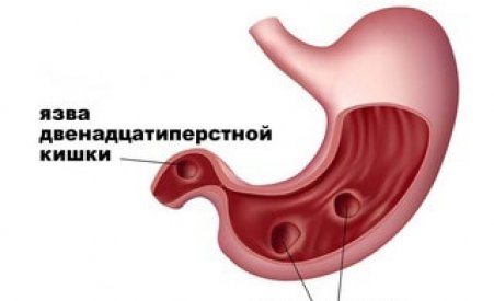Как проявляется язва желудка